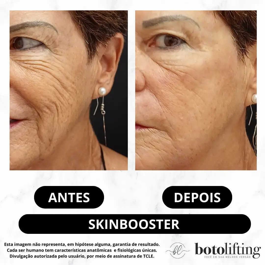 Resultado antes e depois de procedimento de skinbooster na Botolifting Praia Grande