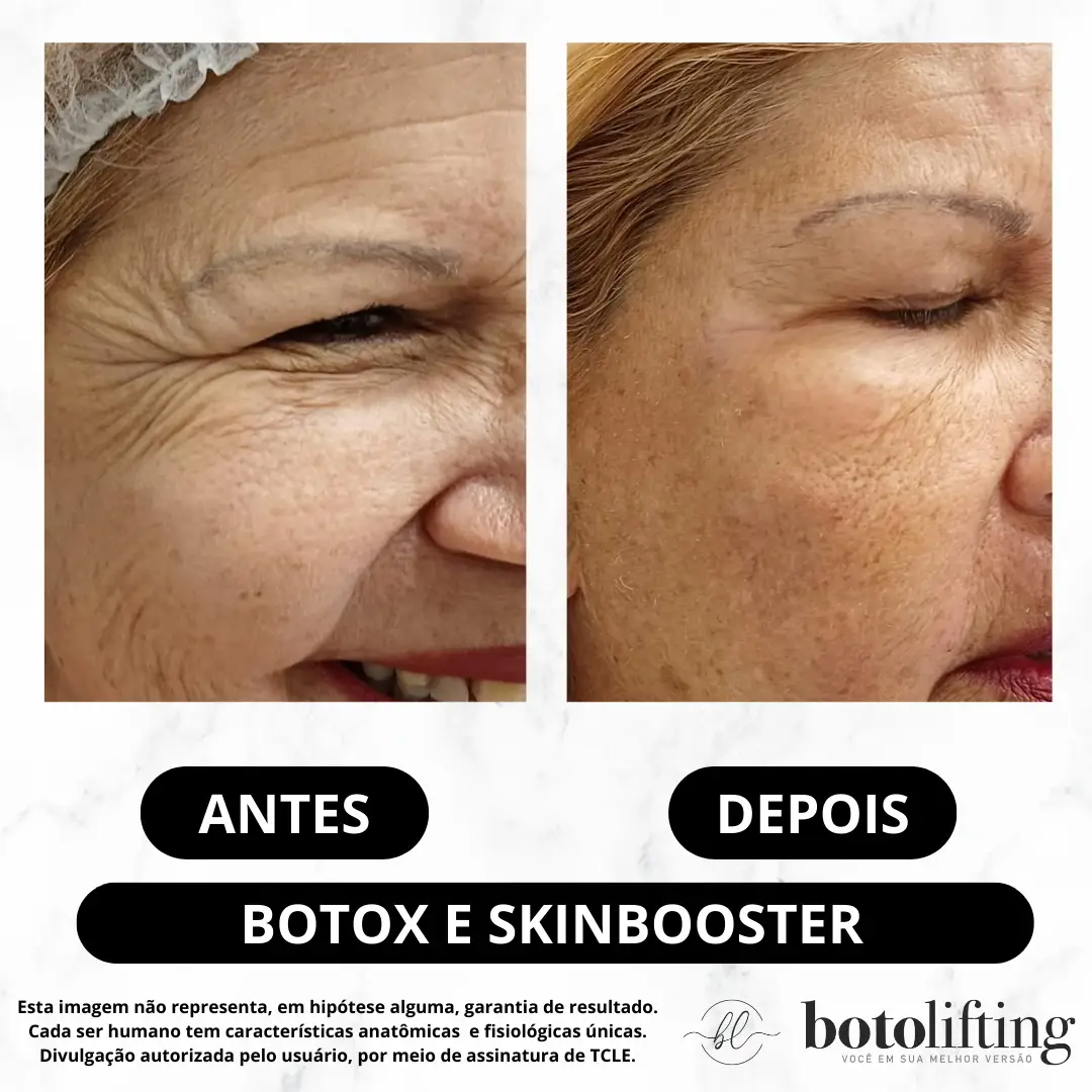 Antes e depois — Toxina e Skinbooster