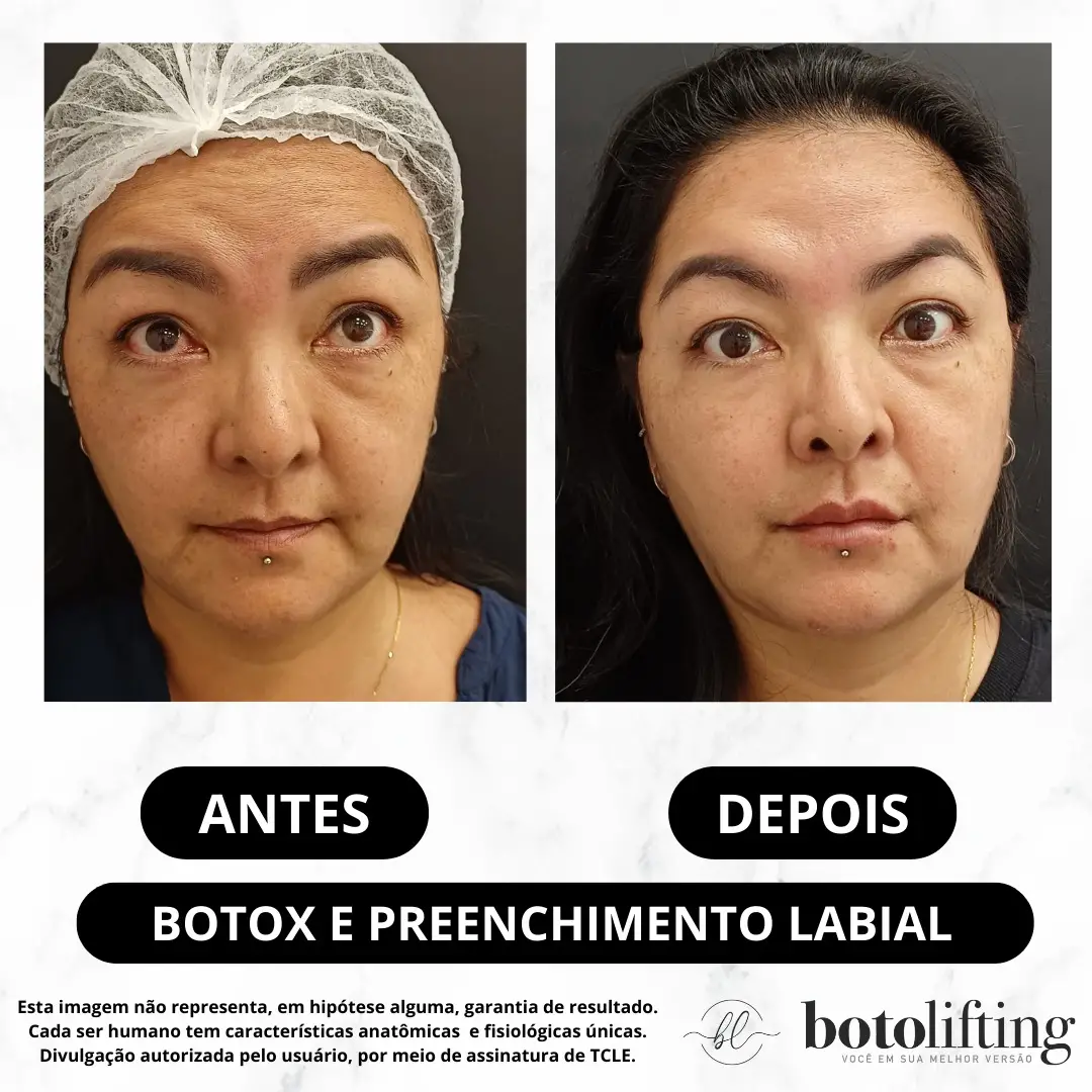 Antes e depois — Preenchimento labial